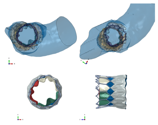 植入左心室和主动脉弓患者特定模型的 tavi 装置的 fem 模型（4realsim | unipa）
