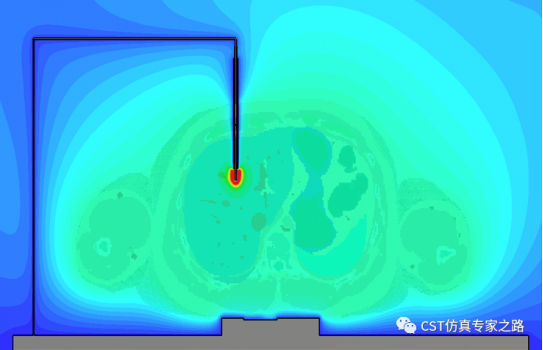cst仿真案例：射频消融术 rfa --- 生物材料，单向多物理耦合，电磁加热